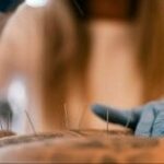 Dry Needling vs. Acupuncture